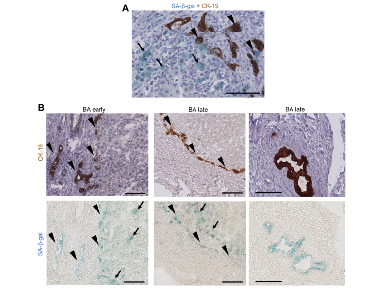 Figure 2. Cholangiocytes and perinodular hepatocytes display cellular senescence in BA livers.