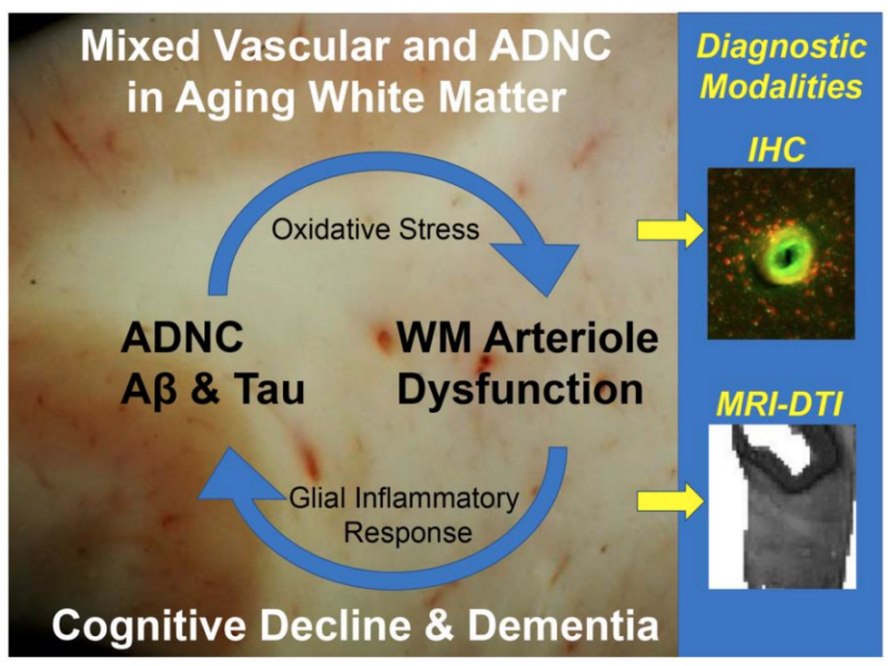 Figure 1. A vicious cycle generating WM injury driven by mixed vascular and ADNC in the aging human white matter.