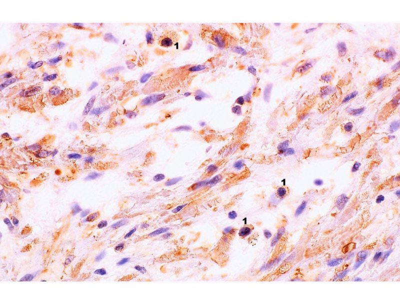 Figure 2. Microscopic image of the expression of the cytoplasmic immunohistochemical reaction to IL-6. A New Connection Between The Gut Microbiota and Prostate Inflammation in Aging Men