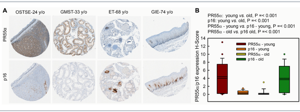 Figure 8. PR55α level is much lower in human normal tissue specimens of older individuals compared to younger individuals and inversely correlates with p16 levels. Human normal tissue specimens derived from various organs/sites were analyzed for differences in PR55α and p16 expression by IHC.