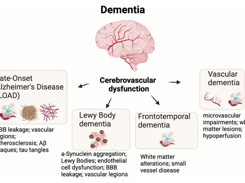 Figure 1. Cerebrovascular dysfunction is an underlying feature of most major types of dementia.